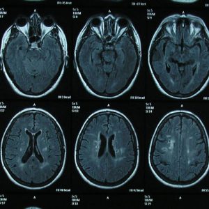 Aprende sobre diferentes patologías relacionadas con el cerebro, identíficando los primeros síntomas que te ayudarán a controlar mejor sus consecuencias.